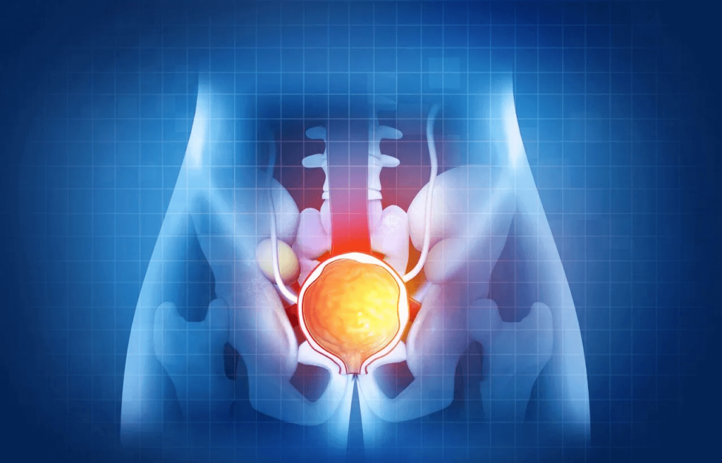 Tratamiento para la Hiperplasia Prostática Benigna (HPB)